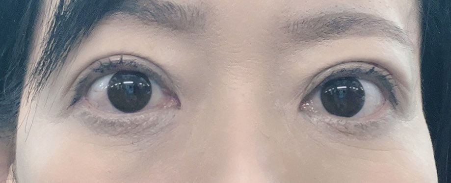 maimaib0123's tweet photo. #埋没ダウンタイム２ヶ月目　#クイックコスメティークダブルNeo  朝は多少幅広になりますが、随分二重幅が落ち着きました。３ヶ月でもっと自然な二重になるそうです。食い込みが強いのは取れにくい方法で縫っているからとの事です。
#QCW #フォーエバー二重術　#二重整形　#埋没法 #埋没経過 https://t.co/rtLewFNZ9s