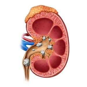 Kidney Stone Quiz

Most common kidney stone type is:

a. Calcium oxalate
b. Struvite
c. Uric acid
d. Cystine

#KidneyStones #HealthQuiz #HealthForAll