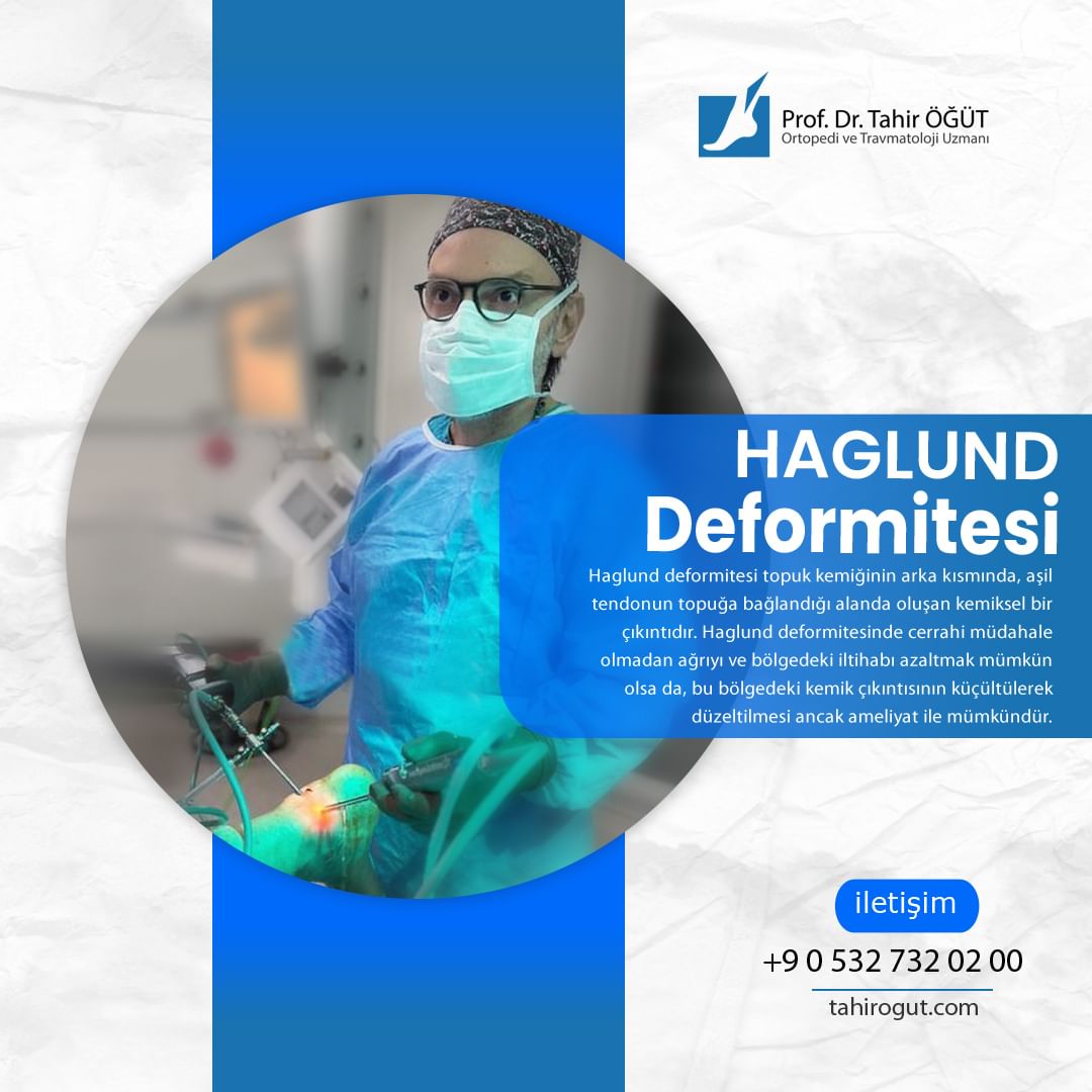 drtahirogut's tweet photo. 📍Haglund Deformitesi

👉🏻Haglund deformitesi topuk kemiğinin arka kısmında, aşil tendonun topuğa bağlandığı alanda oluşan kemiksel bir çıkıntıdır. 

#haglunddeformitesi #haglund #deformite #endoskopik #endoskopikcerrahi #ayakveayakbilegicerrahi #profdrtahiröğüt #tahirögüt https://t.co/PAi3a3QvM8