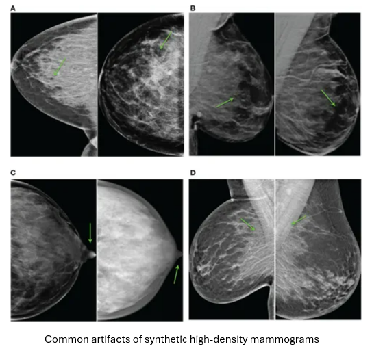 💡Bias in computer-aided detection systems for #breastcancer is increasing risk of late cancer detection in high-density breasts. 📚Read this paper to see how we aim to improve the mass detection performance in high-density breasts: frontiersin.org/journals/oncol… #worldcancerday