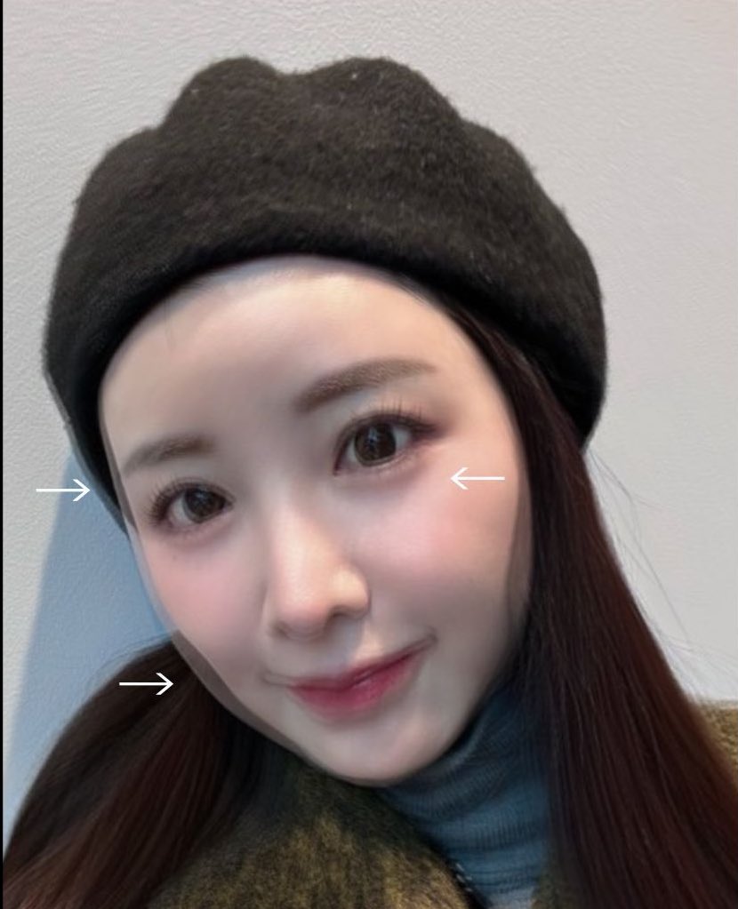 chika_biyouhihu's tweet photo. 中顔面短く見せたかったら！！涙袋の有無、頬の張り感､こめかみ〜額の丸さが中顔面の見え方に大きく影響する！！
という分かりやすい比較画像を作ってみました。

顔の長さや大きさは変わらないのに､面長に見える。。

涙袋の下の影感は中々とれないなと思っていたけど､いざ無くしてみると､不自然な感じもするから､
無くしきれない陰影ってすごく大事かも？と思いますね。

ほうれい線、とか、くまとかね。