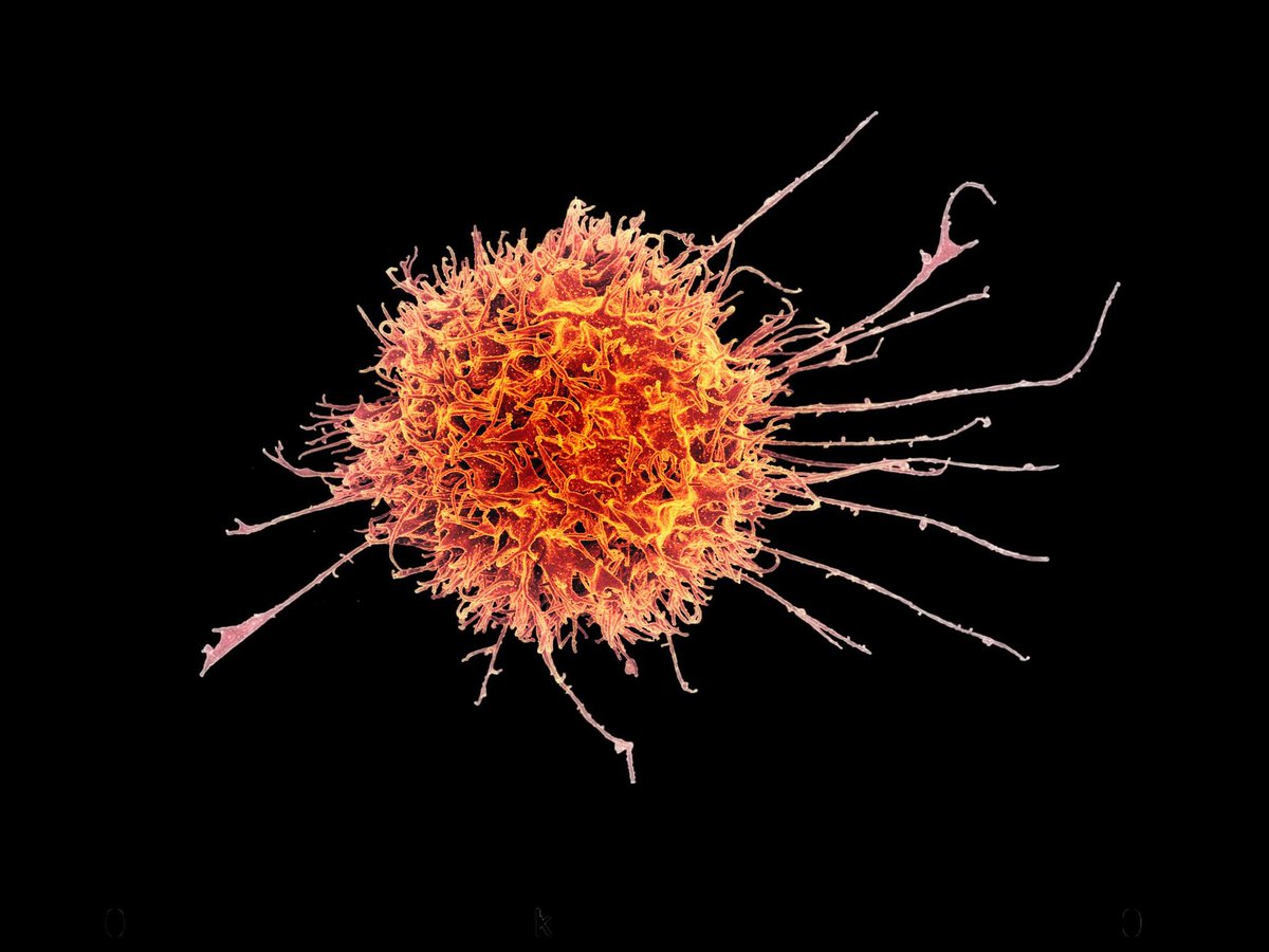 New research reveals how immune cells can lose their 'killer instinct' in cancerous #Tumours, but they can be re-awakened by IL-15 treatment💥 Recently published on @NatureComms, the discovery paves the way for new types of tumour #Cancer treatments 🔬 ➡️bit.ly/3HJP9FS
