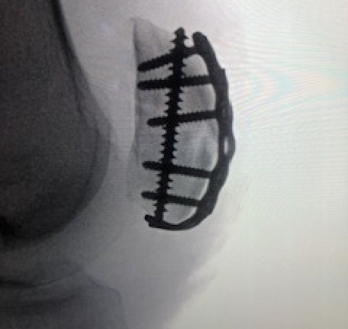 InvictaOrtho's tweet photo. It’s not unusual for a patella clamp to be perfect on one side and gap articular side. For that reason I often use 2 clamps, one superficial &amp; one deeper (with poke through tendon), then fiddle around until it’s perfect (left pic wasn’t final reduction, but wanted to show clamps) https://t.co/i3wW7CdhXi