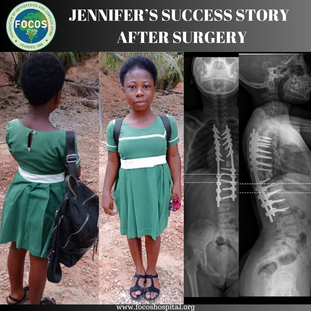 After enduring 6 years with a crippling spine deformity, Jennifer found solace at FOCOS on March 13,2023, diagnosed with life-threatening Congenital Kyphoscoliosis. Thanks to @theaoalliance Jennifer is now pain-free and back to school💙||SWIPE TO SEE JENNIFER AFTER THE SURGERY||