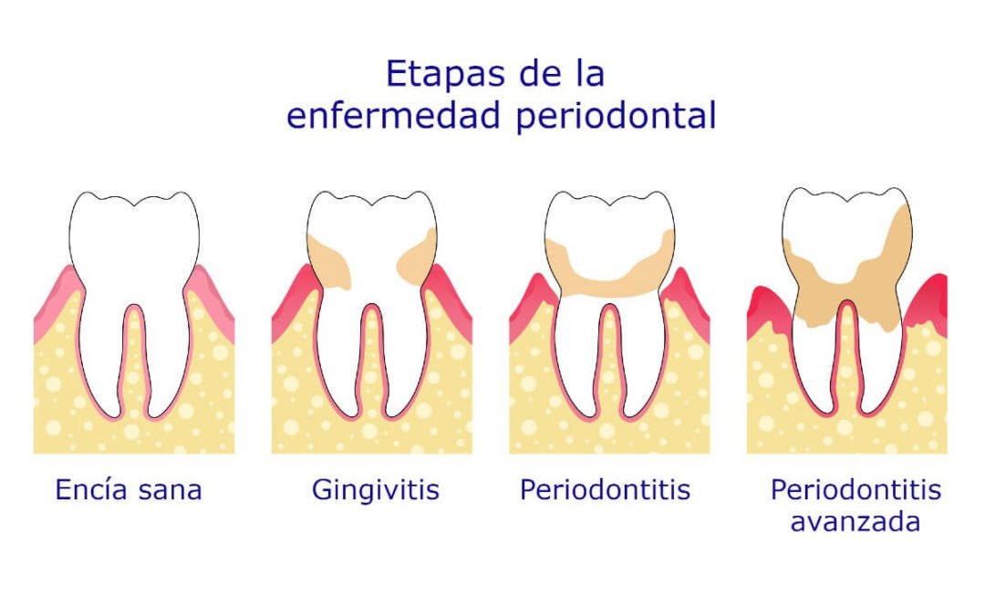 Por qué la periodontitis tiene relación con tantas enfermedades sistémicas, como las cardiovasculares o la diabetes? Estamos muy ilusionados con este trabajo, donde creo que hemos dado con la clave: Un déficit en la disponibiidad de óxido nítrico producido por el microbioma oral