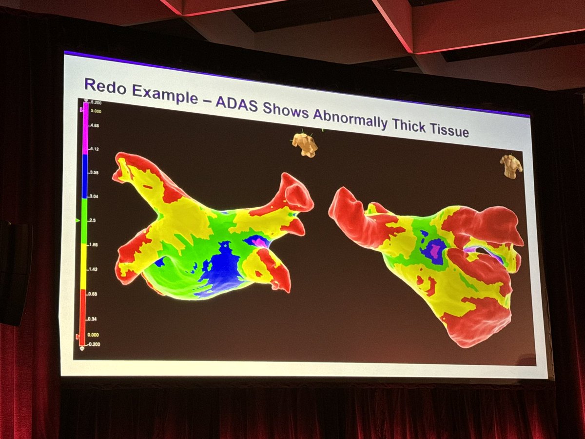 With his talk at #AFSymposium2024, @LarryChinitz continues to drive the advancement of RF PVI efficiency. 

Great look at the data on how he has optimized his HPSD TactiFlex workflows with an emphasis on Flex-tip stability and contact force.

#AbbottProud #TactiFlex