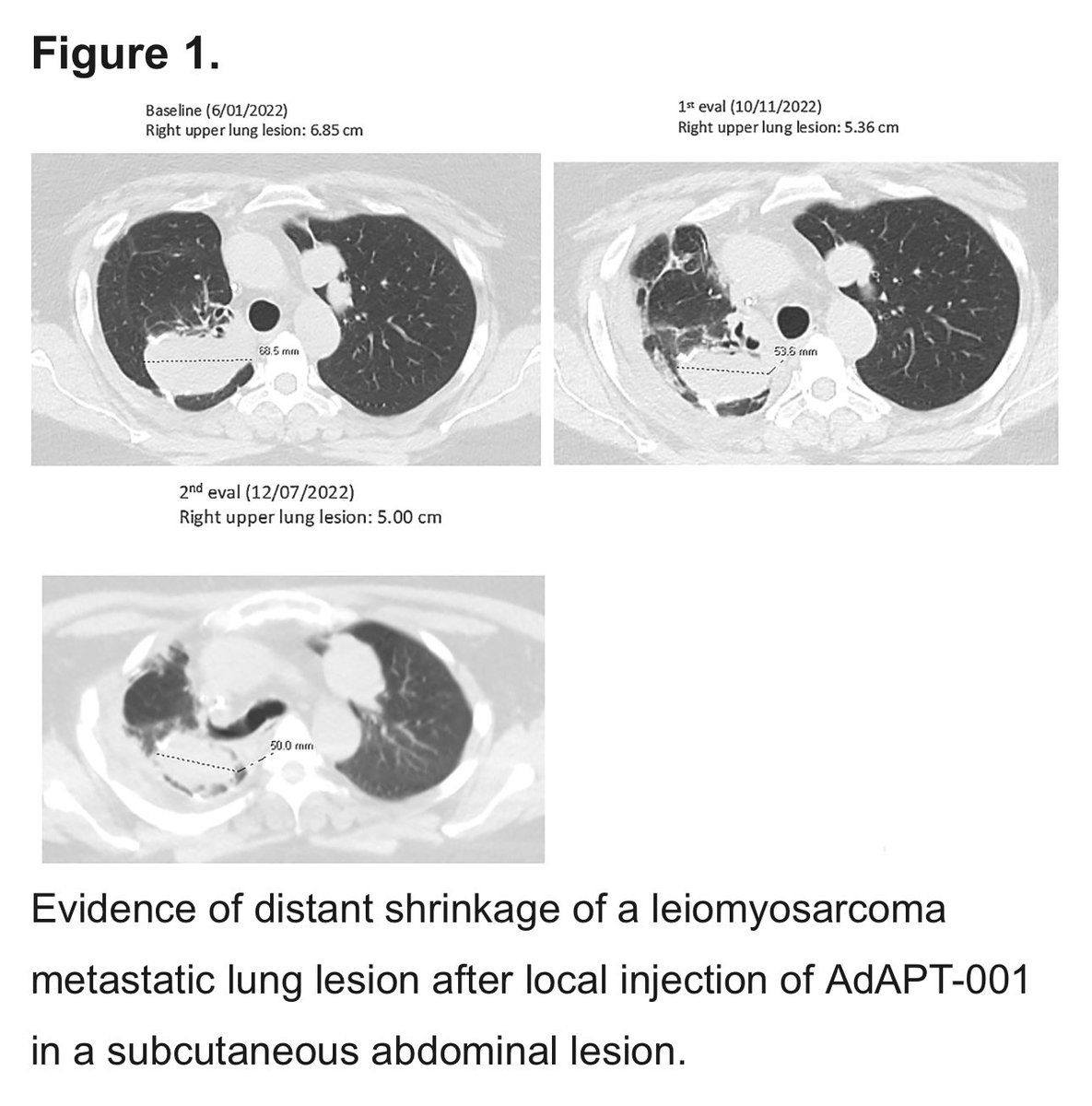 Can intratumoral oncolytic therapy induce regression of distant mets? Check out this example involving an #LMS patient on trial. #sarcoma @MCT_AACR @EpicentRx @MDAndersonNews @VivekSubbiah aacrjournals.org/mct/article/23…