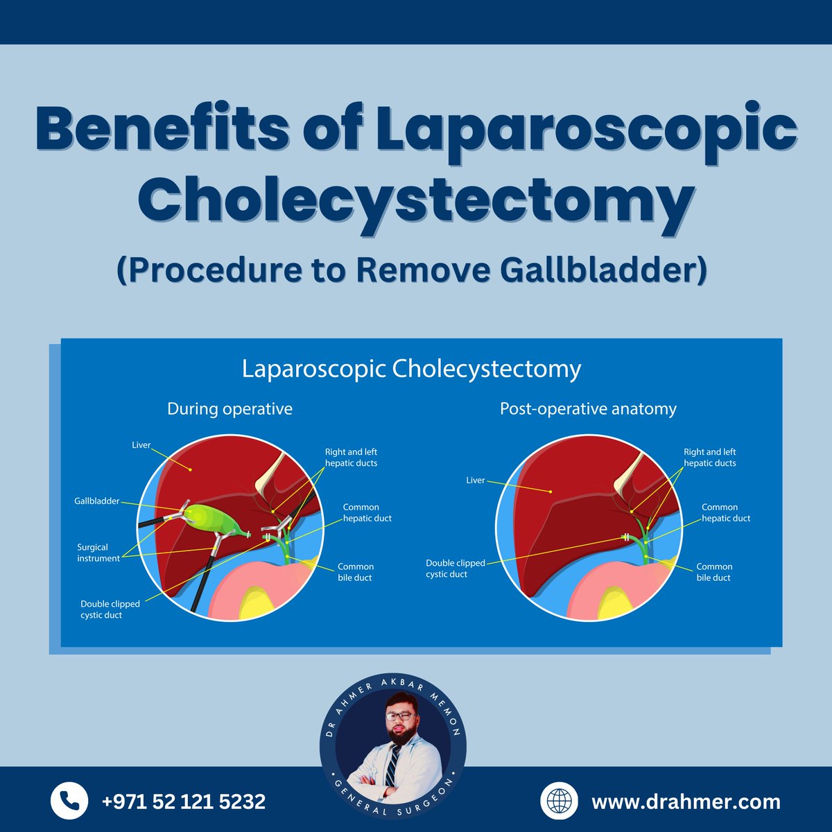 amemondr's tweet photo. Laparoscopic Cholecystectomy is a minimally invasive surgical procedure for gallbladder removal. 

This technique involves small incisions, resulting in minimal wounds or scars, facilitating a swift recovery with reduced pain. 👨‍⚕💯 https://t.co/HkC3CQOqd9