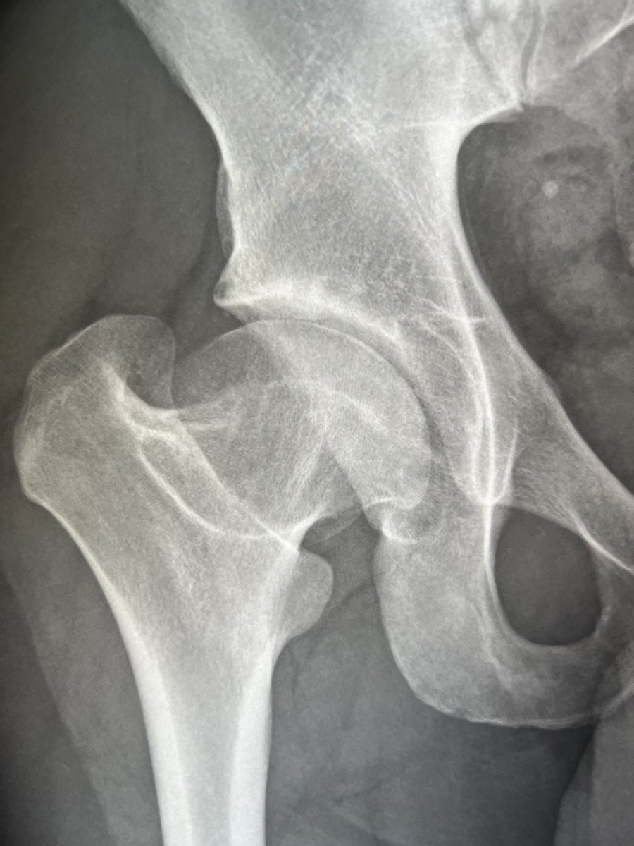 Patient in 30s 
Right Hip pain 

What is it ? 

#radres #radtwitter