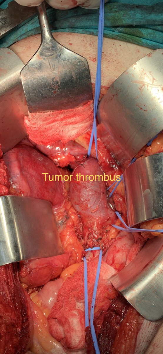 AcademicOner's tweet image. “Successfully navigated complex surgery for renal cell carcinoma today, extracting a tumor thrombus from the inferior vena cava below the hepatic veins. Grateful for our team’s expertise and dedication. #Medicine #SurgerySuccess” @BeslenGoksoy @Selcuk__Erdem @tufantukek