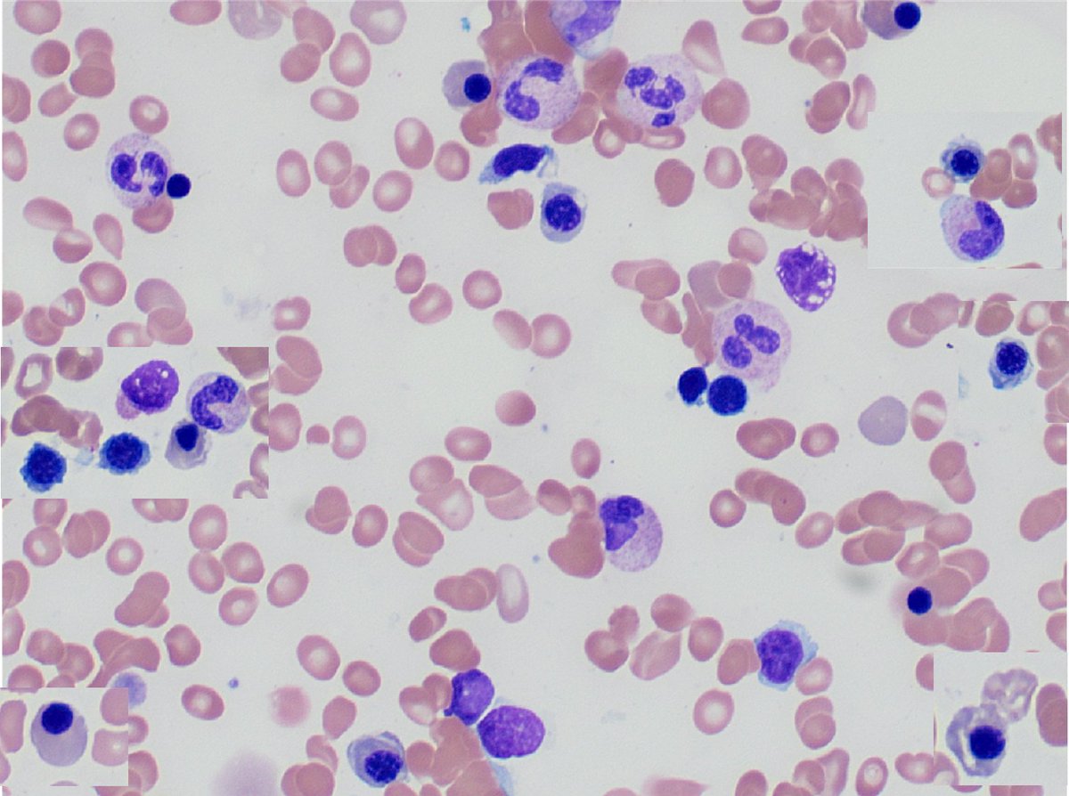 Childhood myelodysplastic neoplasm-low blasts, hypocellular➡️ 🩸Arises in children and adolescents (<18 years of age) 🩸Cytopenia involving one or more lineages 🩸Dysplastic changes in one or more lineages, involving at least 10% of cells 🩸<5% bone marrow blasts and <2%