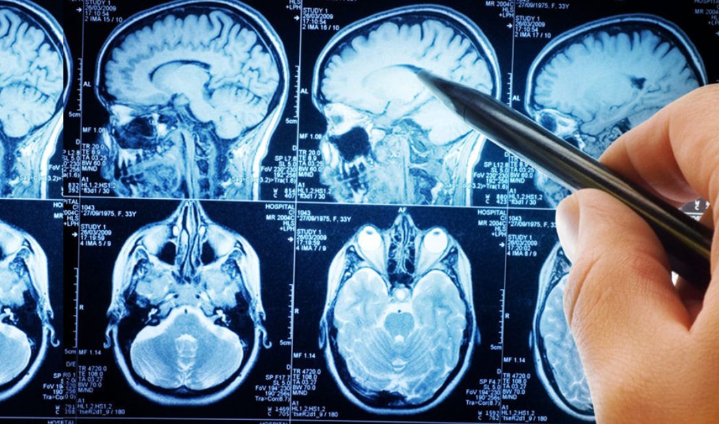 Blackrock Health (@healthblackrock) on Twitter photo 45K+ people in Ireland have epilepsy, this #InternationalEpilepsyDay, you can access info & support from <a href="/epilepsyireland/">Epilepsy Ireland</a>. Our neurology teams provide personalised care for those facing neurological conditions. Learn more here: blackrockhealth.com/treatments-pro… #BetterTogether 45K+ people in Ireland have epilepsy, this #InternationalEpilepsyDay, you can access info & support from <a href="/epilepsyireland/">Epilepsy Ireland</a>. Our neurology teams provide personalised care for those facing neurological conditions. Learn more here: blackrockhealth.com/treatments-pro… #BetterTogether