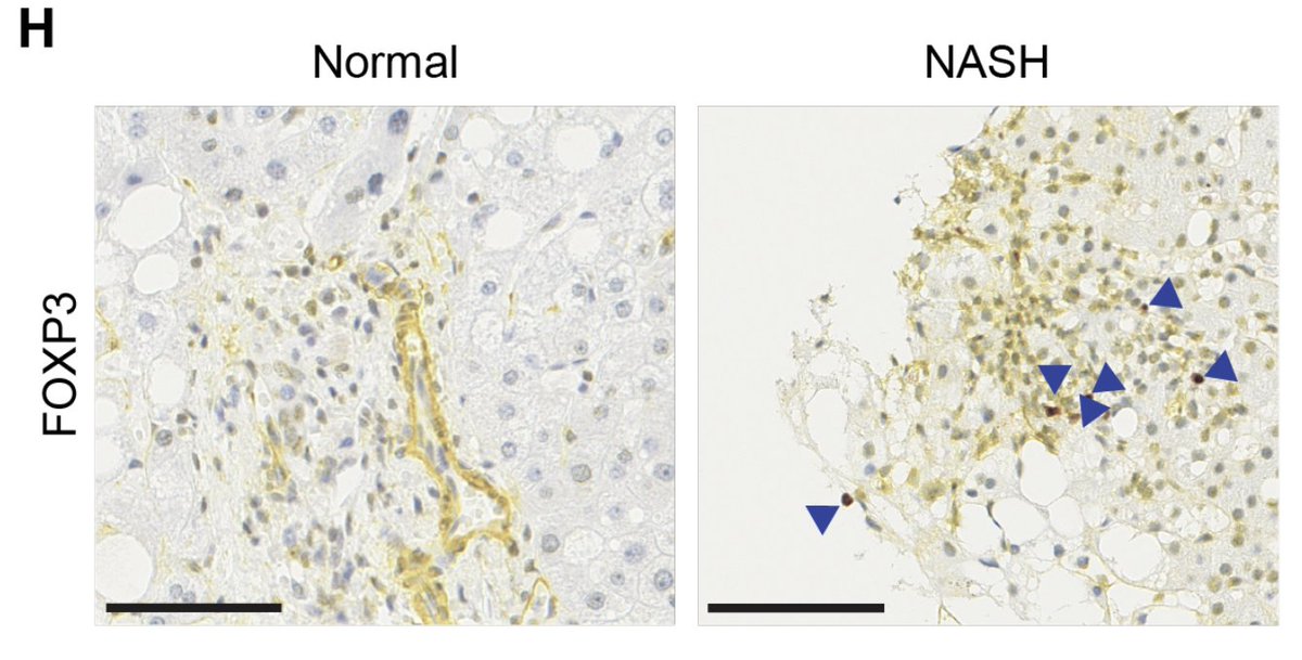 Congrats 🥳 @Thomas_M_Savage and team on a study published today in Immunity demonstrating Treg-derived amphiregulin promotes NASH-induced liver fibrosis and glucose intolerance! 🧑‍🔬🍔🍟 @ColumbiaCMBS @Columbia_MI @cudldrc @MD_PHD_CUMC_VPS tinyurl.com/2ptfr8wf
