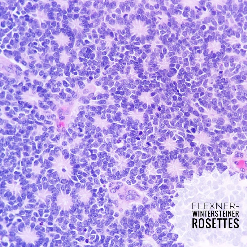 True rosettes in a retinoblastoma #pathresidents #neuropath