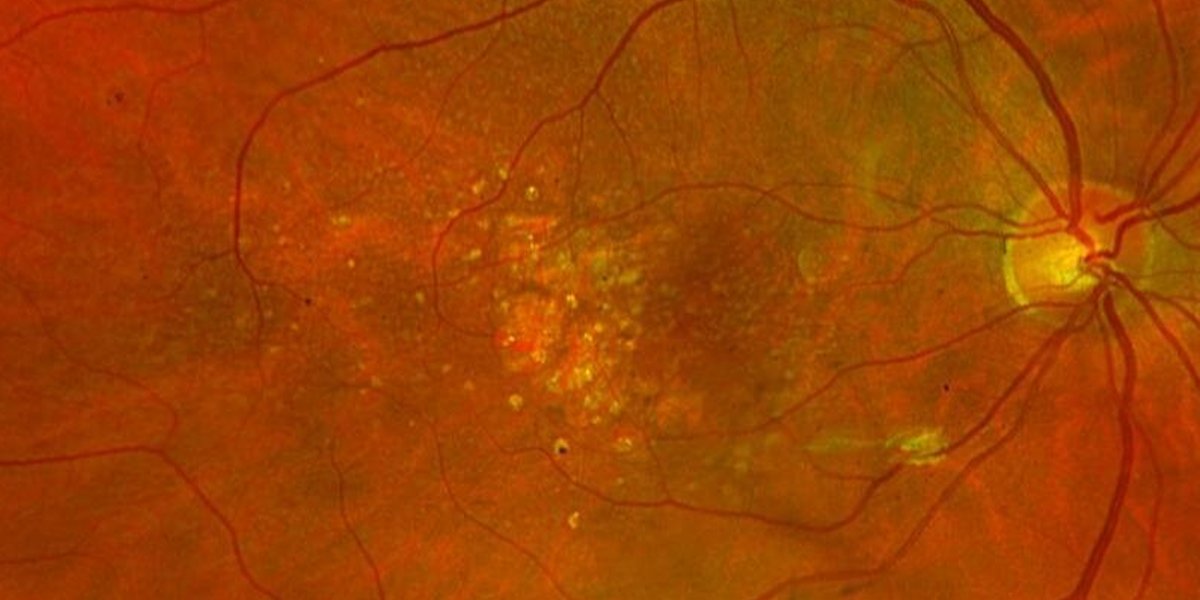 It's Age-Related #MacularDegeneration (AMD) Month, so learn about #pegcetacoplan, the first treatment available for geographic atrophy secondary to AMD. #ophthalmology ow.ly/u5z150QvZAL