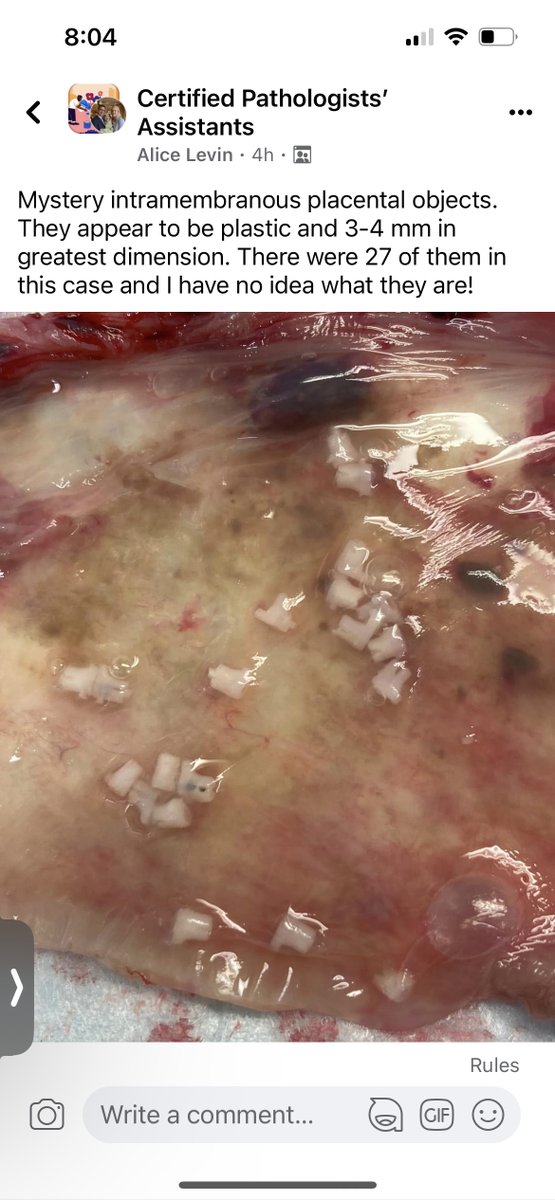leon_metlay's tweet image. Mystery #ForeignObjects in a #Placenta
This image was emailed to me by one of our PAs. Anyone know what these objects are? 
Being shared with consent from the PA
@yro854