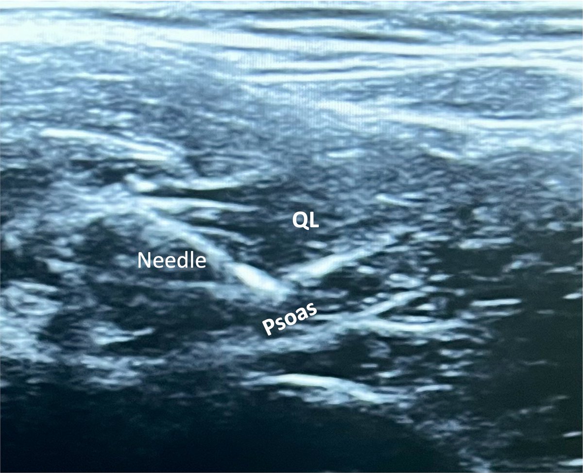 NAPEN Anestesiologia USP (@napen_icr) on Twitter photo 5-year-old undergoing orchiopexy with general anesthesia and a QL block. Curious about QL block types in children. Considering the limited interfascial space and local anesthetic volume, does QL block classification become inapplicable? Thoughts?<a href="/baby_blocks/">baby-blocks</a> #PedsAnes 5-year-old undergoing orchiopexy with general anesthesia and a QL block. Curious about QL block types in children. Considering the limited interfascial space and local anesthetic volume, does QL block classification become inapplicable? Thoughts?<a href="/baby_blocks/">baby-blocks</a> #PedsAnes