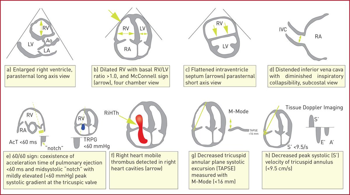 ZHeart11768530's tweet photo. 🔴 2019 ESC Guidelines for the diagnosis and management of acute pulmonary embolism

https://t.co/cW4qmmN1S0
 #Cardiotwitter #MedEd #CardioEd #cardiology #echofirst #cardioEd #Cardiology #medtwitter https://t.co/Eu7NcytOuL