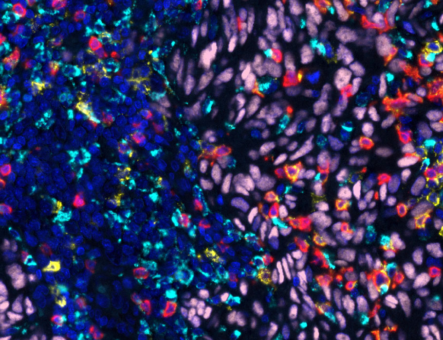 A phase I clinical trial with 13 patients reveals that the connectivity of #MyeloidCell networks in the #tumor microenvironment may correlate to success rates for adoptive cell therapy during metastatic #melanoma. <a href="/CoukosGeorge/">George Coukos</a>

scim.ag/5K9