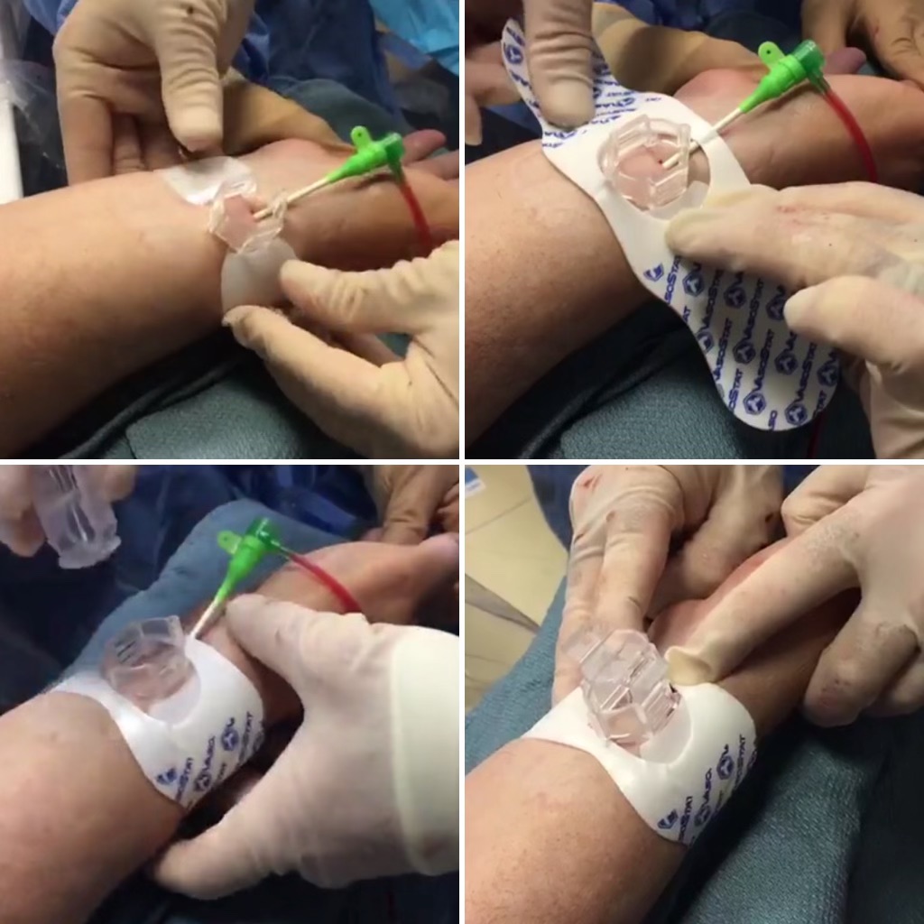 ForgeMedical's tweet photo. 4 simple steps to achieve quicker patent hemostasis. #VasoStat #focusedcompression #radialfirst   
- Attach base 
- Apply adhesive pad
- Depress plunger while removing sheath 
- Check pulse to confirm patent hemostasis https://t.co/aCO2KM9kHn