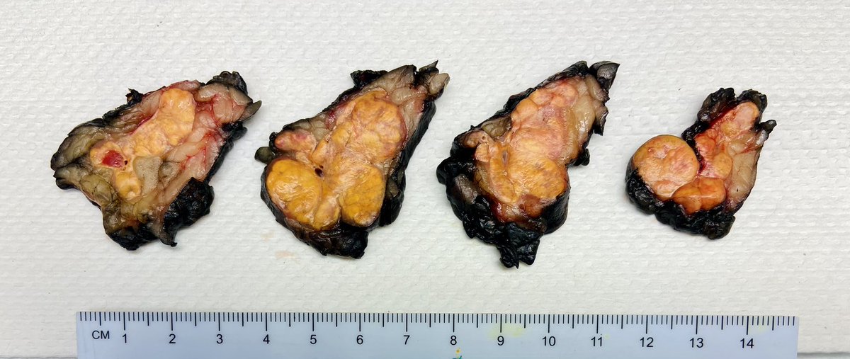 Here’s a cool case we received recently. What is the organ and diagnosis? It probably would have fooled me!

#pathtwitter #MedTwitter #pathresidency #pathresidents #gupath #pathassist