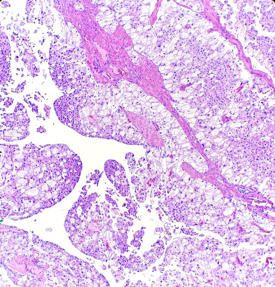 path_girl88's tweet photo. Chromophobe renal cell carcinoma 🤩. What do you stain with? #pathtwittter #MedTwitter #pathology #GUpath https://t.co/qnOHgWo7tm