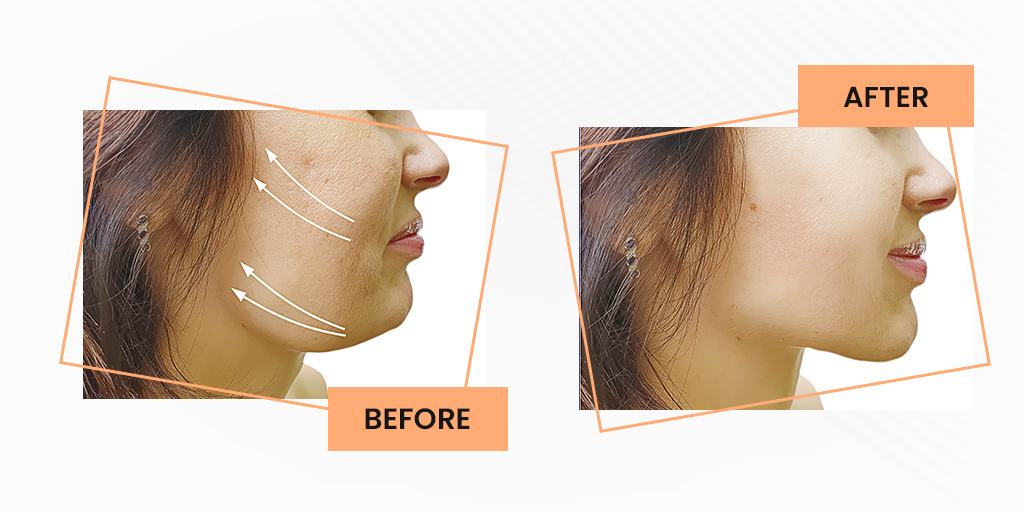 No need to go through the rest of your life with a double chin.
We excel at contouring the best chins without undergoing surgeries. #ReduceDoubleChin #DoubleChin #DoubleChinTreatment #DoubleChinReduction #ExercisesForDoubleChin