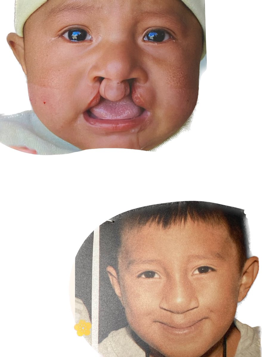 jerriDGA's tweet photo. In my newest film Smiles In Tecate, witness the remarkable transformation in children with cleft lip and palate disease after volunteer doctors perform free surgery in third world countries. We have just won our 4th Award; Paris, Berlin, IndiFest and The Short Film Competition. https://t.co/ibDWICiwYy