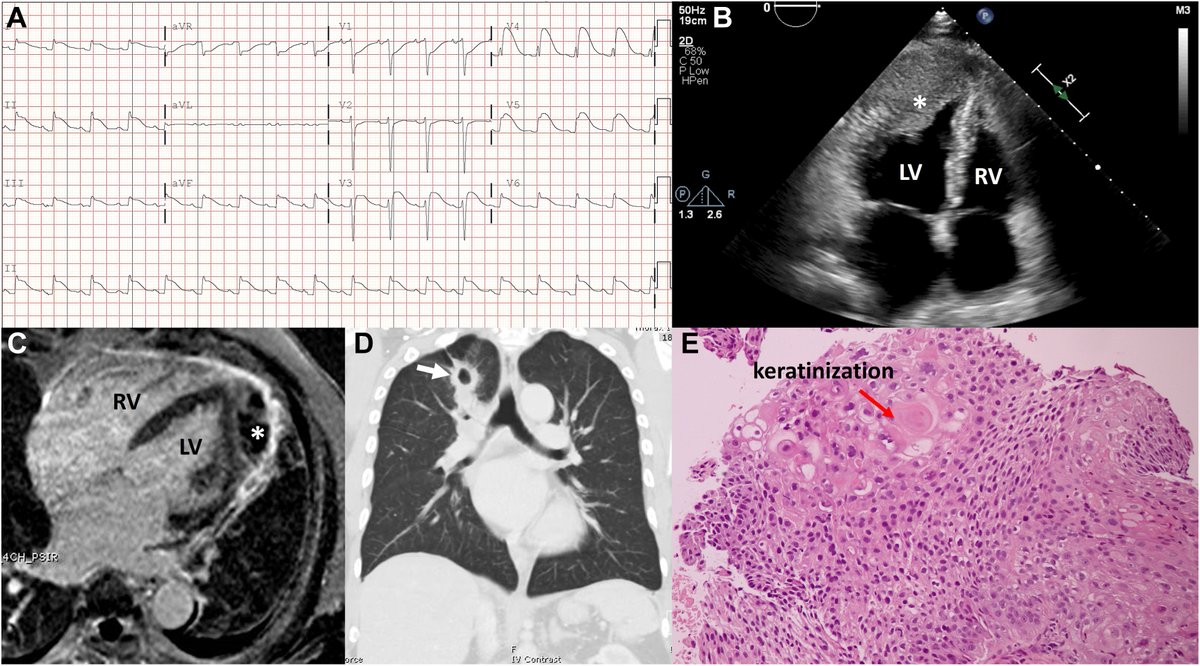 #CoolCaseoftheMonth: Direct invasion of the myocardium from metastasis, even without coronary obstruction, can result in clinical picture that mimic STEMI! 👉 cjcopen.ca/article/S2589-… #CJCOpen