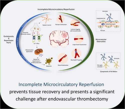AshuJadhav (@ashupjadhav) on Twitter photo Management of Incomplete Microcirculatory Reperfusion After Endovascular Thrombectomy: Focus on Inhibition of the Glycoprotein IIb/IIIa Receptor Pathway | Stroke: Vascular and Interventional Neurology ahajournals.org/doi/full/10.11… <a href="/StrokeAHA_ASA/">Stroke AHA/ASA</a> <a href="/SVINJournal/">Stroke: Vascular and Interventional Neurology</a> <a href="/svinsociety/">SVIN</a> Management of Incomplete Microcirculatory Reperfusion After Endovascular Thrombectomy: Focus on Inhibition of the Glycoprotein IIb/IIIa Receptor Pathway | Stroke: Vascular and Interventional Neurology ahajournals.org/doi/full/10.11… <a href="/StrokeAHA_ASA/">Stroke AHA/ASA</a> <a href="/SVINJournal/">Stroke: Vascular and Interventional Neurology</a> <a href="/svinsociety/">SVIN</a>