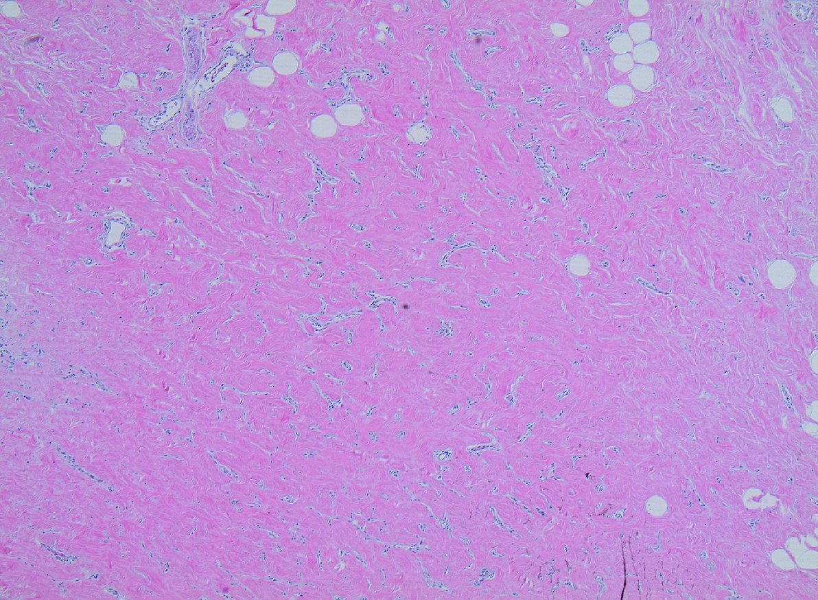 Everyday #breastpath Pseudoangiomatous Stromal Hyperplasia (PASH)