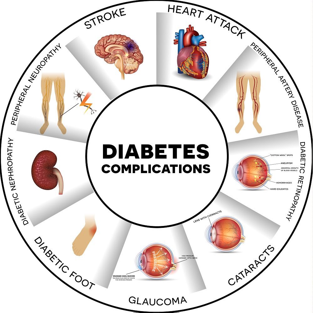 NOT ALL DIABETES IS THE SAME:

🔺 Pts w DM & preop micro or macrovascular complications are 2️⃣ times less likely to achieve remission after RYGB or SG

🔺There is an additive effect: greater number of complications associated with lower remission rates

link.springer.com/article/10.100…