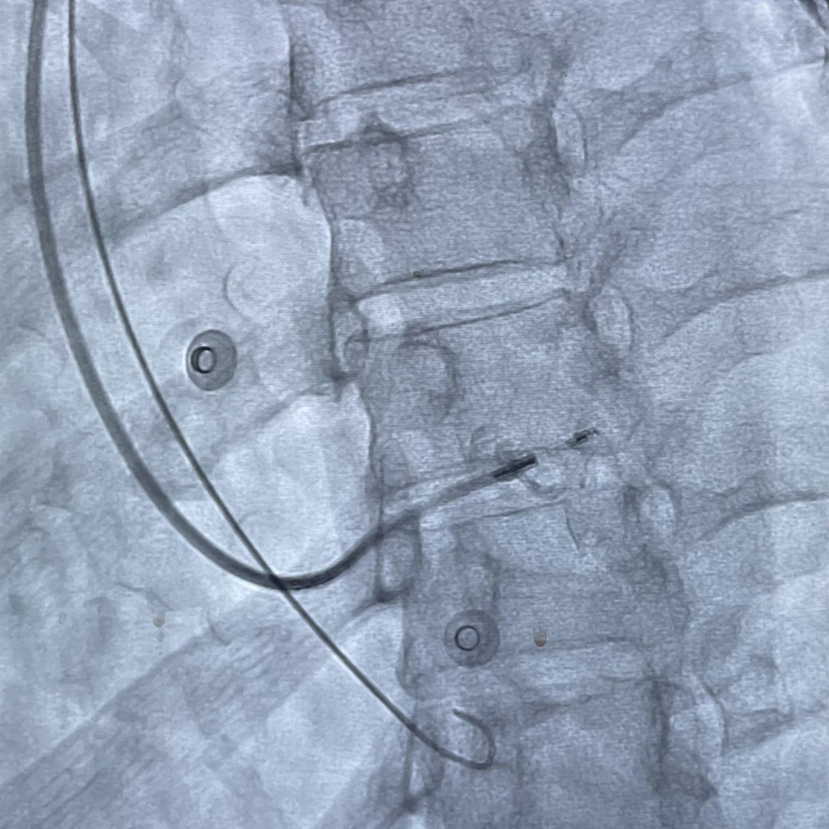 First left bundle branch area pacemaker (C315-HIS &amp; 3830 system) with <a href="/pichmanil/">Pichmanil Khmao</a> and John McFadden (rep) in Cambodia; from last week's <a href="/JHMedMinistry/">Jeremiah’s Hope Clinic - Cambodia</a> mission. Thank you <a href="/Medtronic/">Medtronic</a> for device donations to help local EP teams learn skills to treat low-income patients. <a href="/srissundaram/">Sri Sundaram</a>
