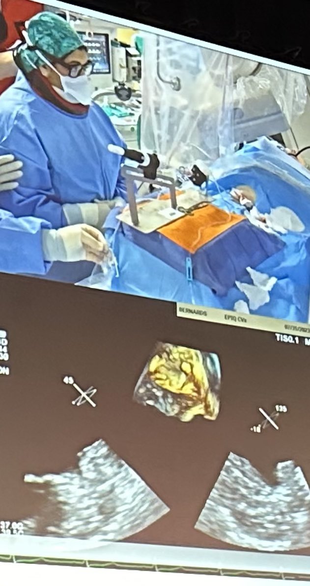 ✨Now you see it, now you don’t!✨

So exciting seeing @Drdevignair present her recorded case of rotational LAA closure with the Laminar device at @AFSymposium 2024. Mind-blowing technology in the field of #stroke prevention with #LAAC in patients with #afib! #ARG @StBernards