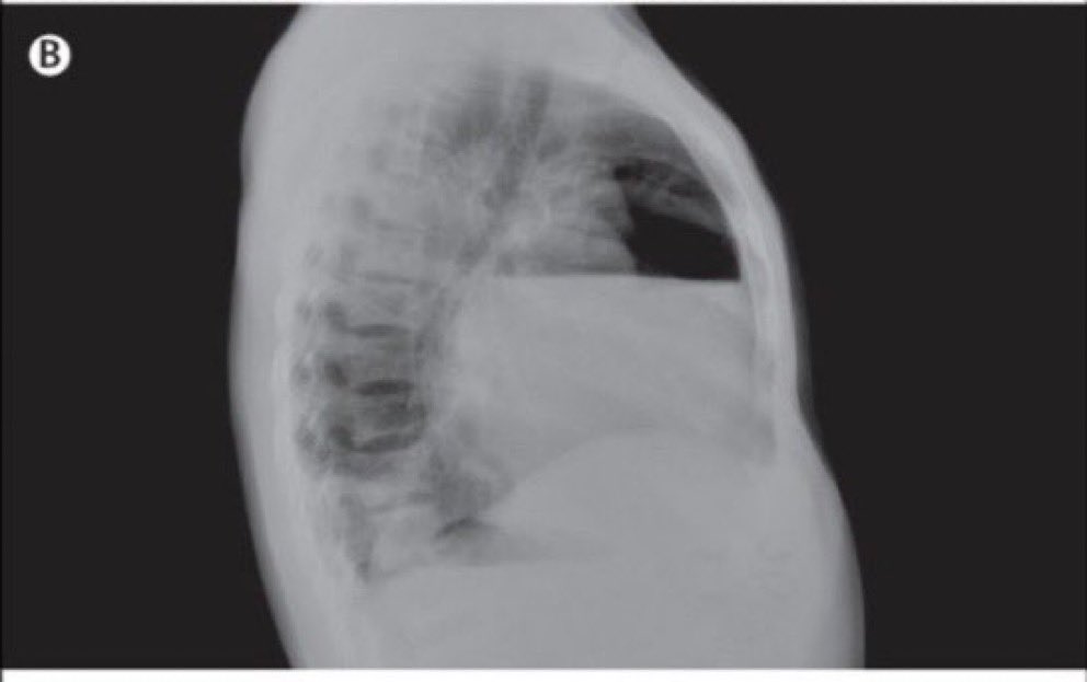 37-year-old man w/ESRD & chronic uremic pericardial effusion p/w worsening dyspnea, orthopnea, 4 days after a nephrectomy to control HTN. Exam w/⬆️RR, HR, BP 110/70 mm Hg w/ 25 mm Hg paradoxical changes. Lungs w/L basilar bronchial breath sounds. What is the cause of this CXR?