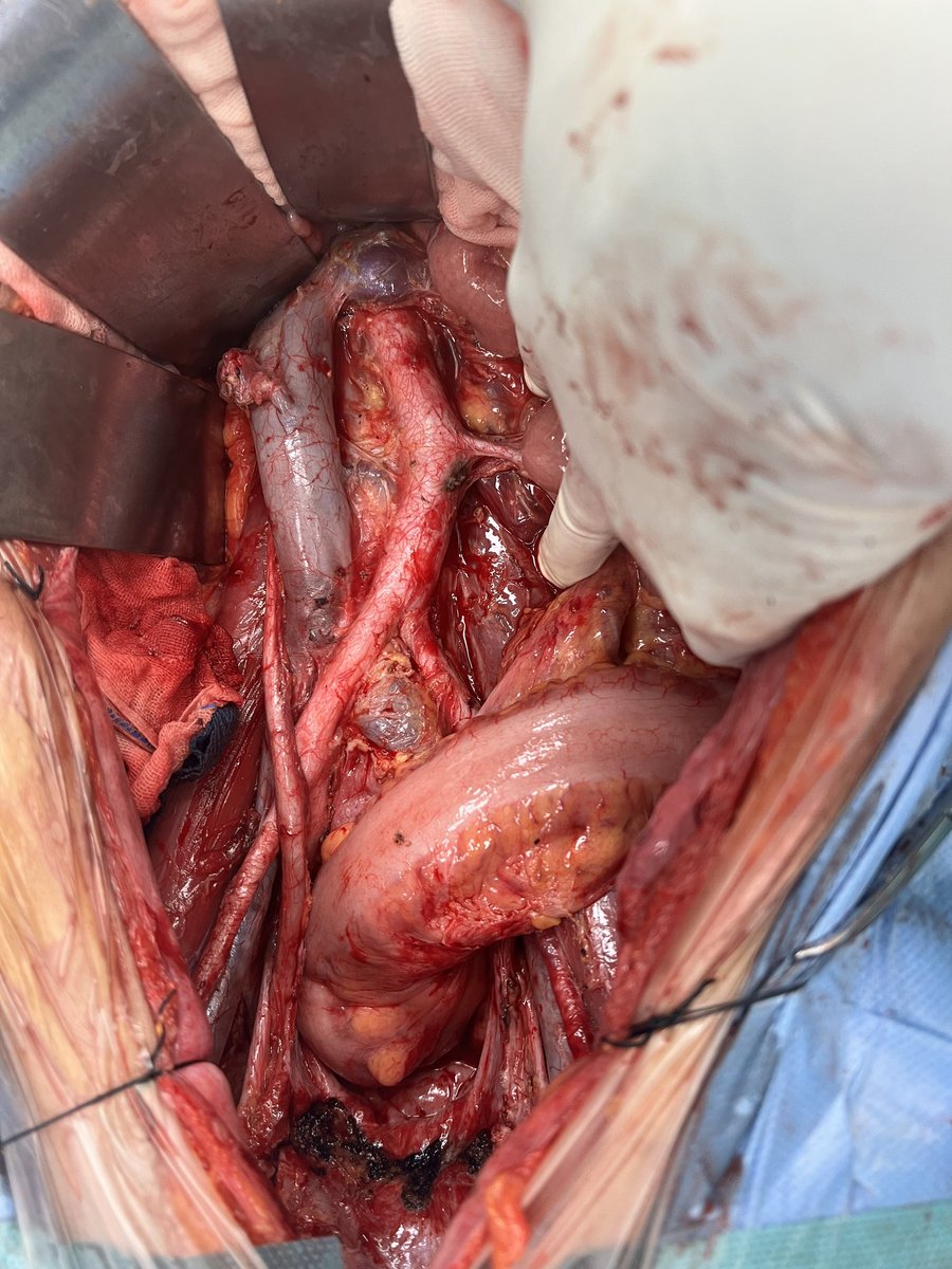 RichardJing4's tweet photo. ≥8 OC surgeries + many more procedures for pts with EC &amp; CC in high volume centers such as Sun Yat-sen Memorial Hospital.  OR resource is limiting. Exploring the  feasibility of HIPEC in General Wards is highly warranted. GARD-HIPEC is expected to enroll the 1st pts within  3 m! https://t.co/l9vli8ZbY2