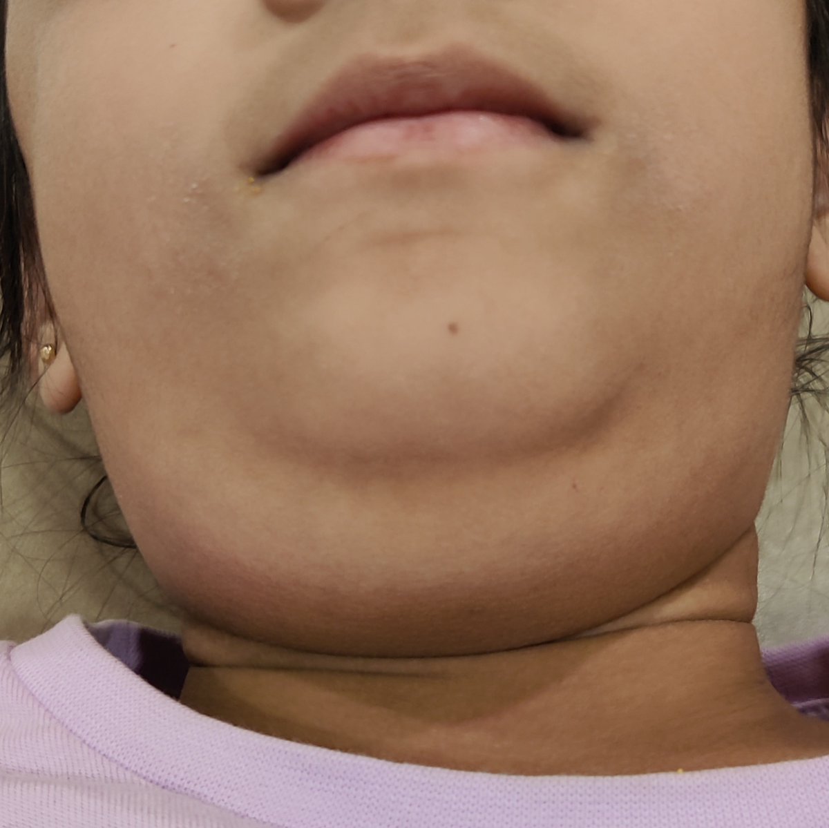 Snehal_Spandan's tweet photo. Mumps is a contagious infection of Salivary glands. We are seeing an unusually large of number of cases this year. It causes swelling near both the ears on cheeks and in the neck also, along with fever and pain. Kids have difficulty in chewing too. https://t.co/FPsM3mgJdq