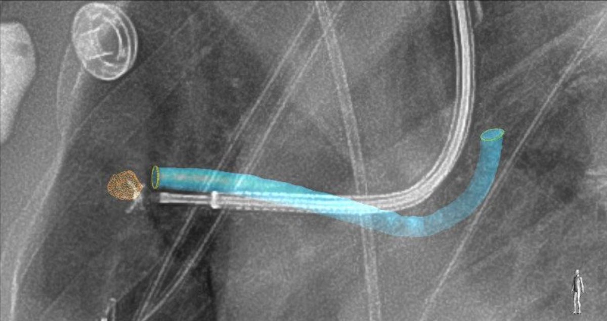 ahalraiyes's tweet photo. Lung nodule service at Advocate Lutheran General Hospital
5 mm lung nodule biopsy by #roboticbronchoscopy @IntuitiveSurg supported by real-time Imaging #SmartCT @PhilipsHealth @advocatehealth . Live image for device guidance through non-vascular structures is validated https://t.co/GmTs1w3DuB