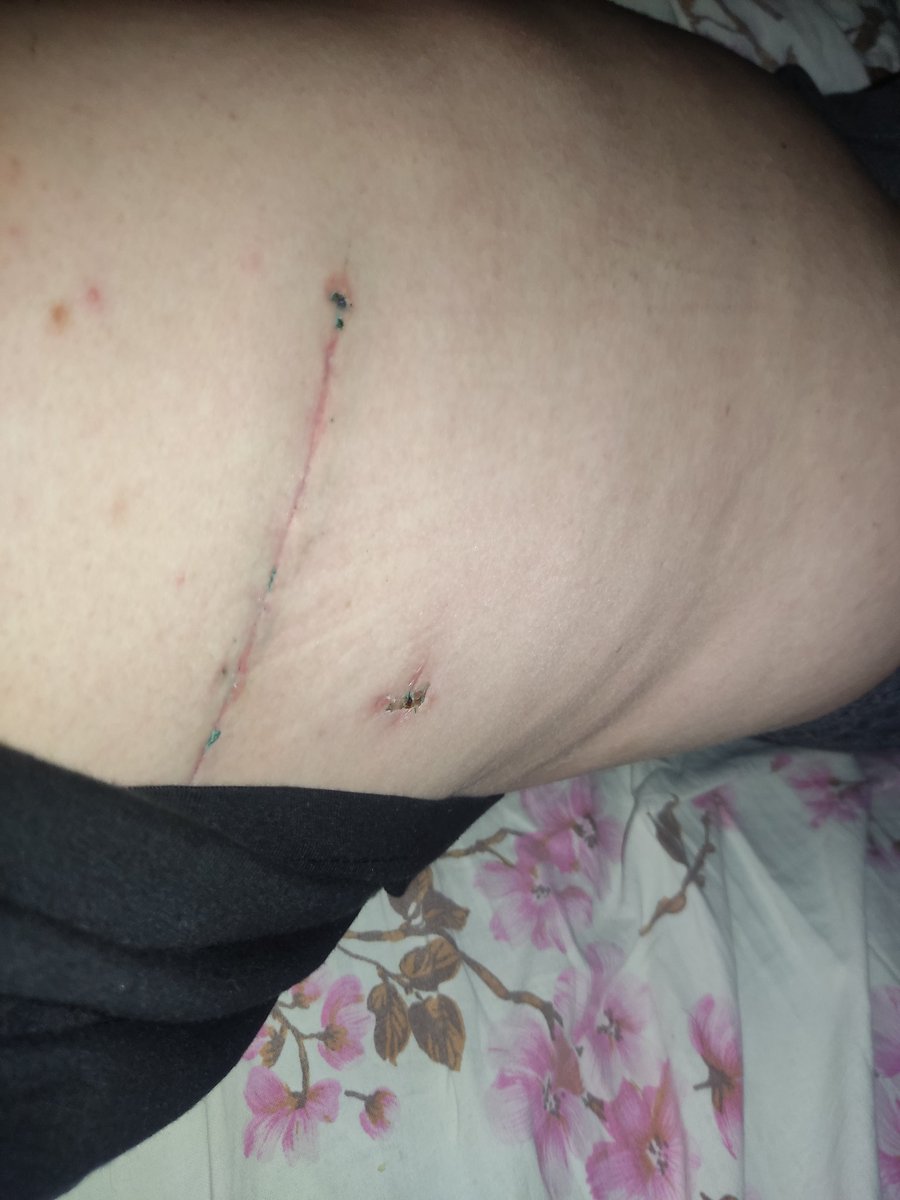 Punkcore88's tweet image. За то время, что меня не было я кстати успел полежать в туберкулёзном диспансере, перенести операцию (биопсию, но старым способом) и теперь немного у пеня другая работа. Таблетки ещё полгода пить надо.