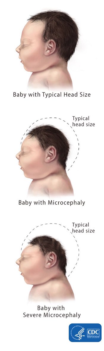 Zika virus and pregnancy

Zika can cause serious birth defects, including microcephaly and other brain abnormalities. Microcephaly can lead to lifelong problems, such as seizures, feeding problems, hearing loss, vision problems, and learning difficulties.

There is no vaccine 💉