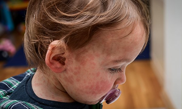 UK measles surge: a guide for nurses A surge in measles cases has prompted the UKHSA to declare a national incident. Find out everything you need to know, from symptom recognition to vaccine uptake. rcni.com/nursing-standa…