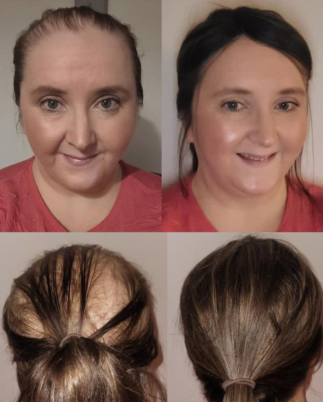 UniwigsC's tweet photo. Tired of dealing with fine, lifeless hair? Our topper is the ultimate solution! Experience an instant lift in volume and thickness thatβll leave you amazed. π
#uniwigs #UniWigs #wigs #hairtoppers #hairpatches #hairstyles #hairloss #humanhairwigs #syntheticwigs https://t.co/4oYjHBOnph