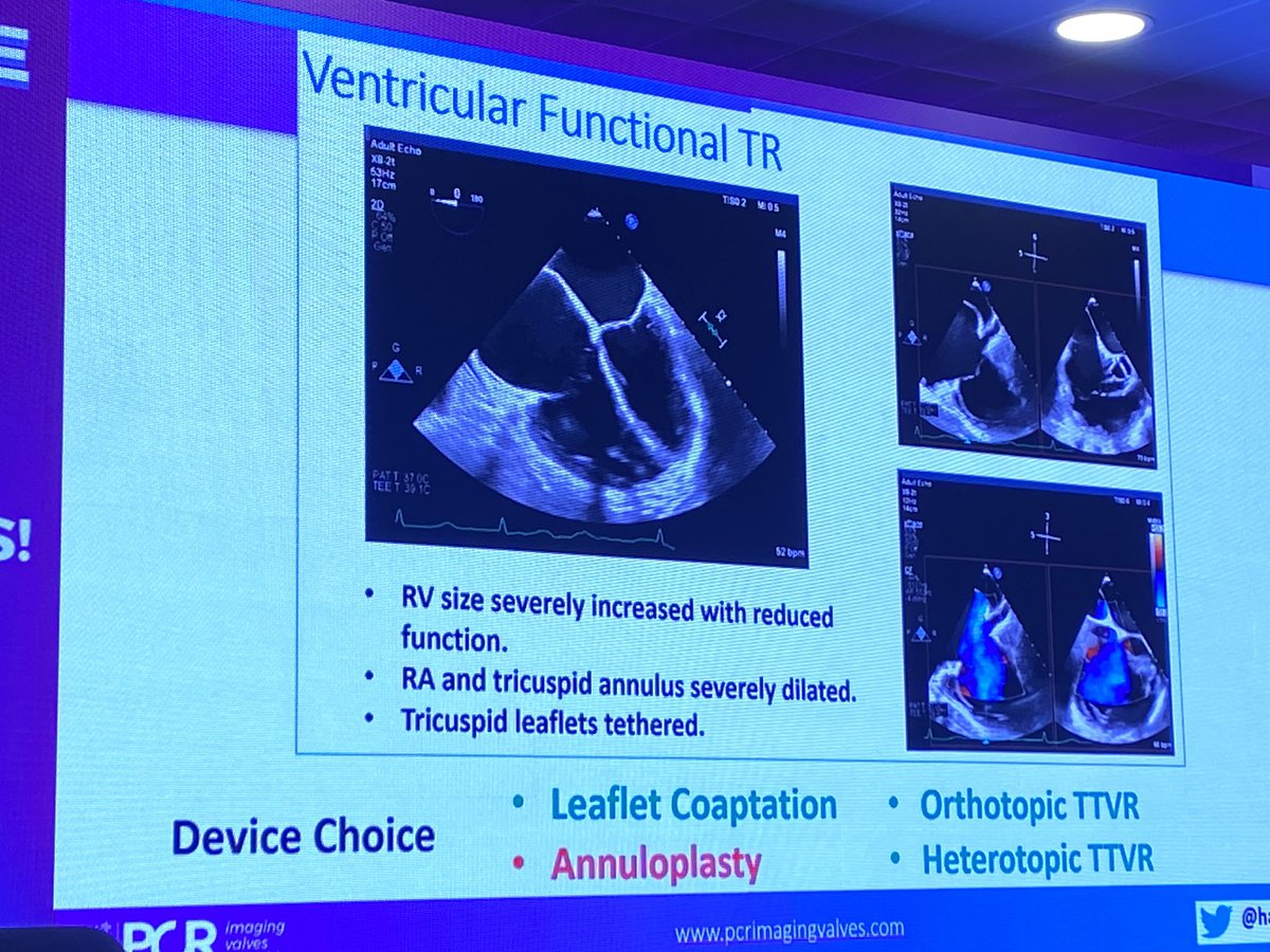 Imaging to guide TV transcatheter device choice: atrial STR is the only phenotype that can be treated by all device types Beautiful presentation by the leading expert in the field @hahn_rt at #PCRMadrid @PEPEZAMORANO @NAjmoneMarsan @VDelgadoGarcia @DonalErwan @Ph_Bertrand…