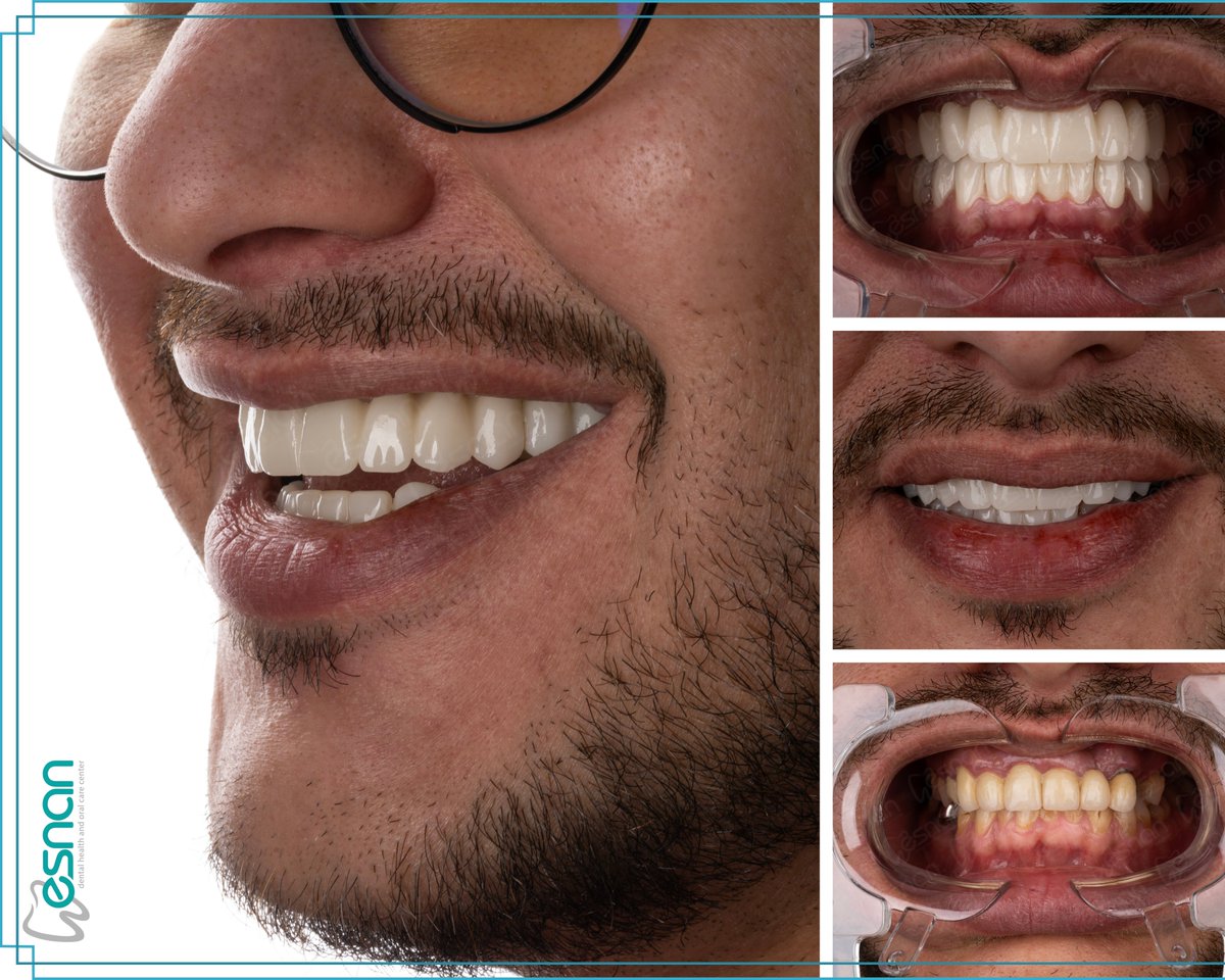 esnanclinics's tweet image. Embrace a new era of smiles with Esnan Dental Clinic's dental implants! 🌈🦷Expert care, advanced technology, and a team dedicated to your smile. Let's bring back your confidence! For a life-changing smile makeover, visit esnan.com.tr

#NewSmiles #EsnanDental #implant