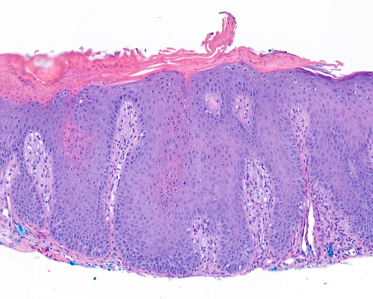 World's tiniest (2 mm) verruciform xanthoma -- go figure. It was on the cheek -- go figure. He was 90 -- go figure.