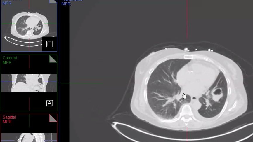 estelais's tweet photo. Hybrid Imaging Virtual Workshop @MyASNC @DCalnon
▶️62 yo F. Chest pain
👉82Rb #ThinkPET ➡️ 
👉CT: cavitated lesion + pleural effusion + soft tissue mass associated w loss of volume (switch to mediastinal window) + lymph nodes
➡️Squamous cell carcinoma🌟 https://t.co/w5TIGm3RyQ