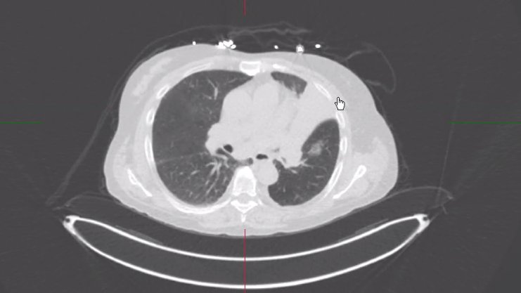 estelais's tweet photo. Hybrid Imaging Virtual Workshop @MyASNC @DCalnon
▶️62 yo F. Chest pain
👉82Rb #ThinkPET ➡️ 
👉CT: cavitated lesion + pleural effusion + soft tissue mass associated w loss of volume (switch to mediastinal window) + lymph nodes
➡️Squamous cell carcinoma🌟 https://t.co/w5TIGm3RyQ