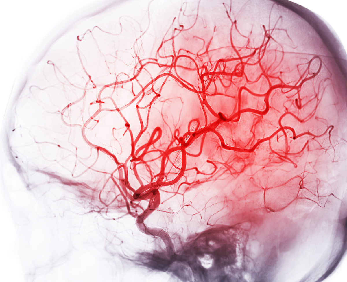 In a @JAMANeuro study, a YSM team led by @sheth_kevin finds faster treatment of #hemorrhagic #stroke or “#brain bleed” significantly improves a patient’s chances of #survival: brnw.ch/21wGRmz