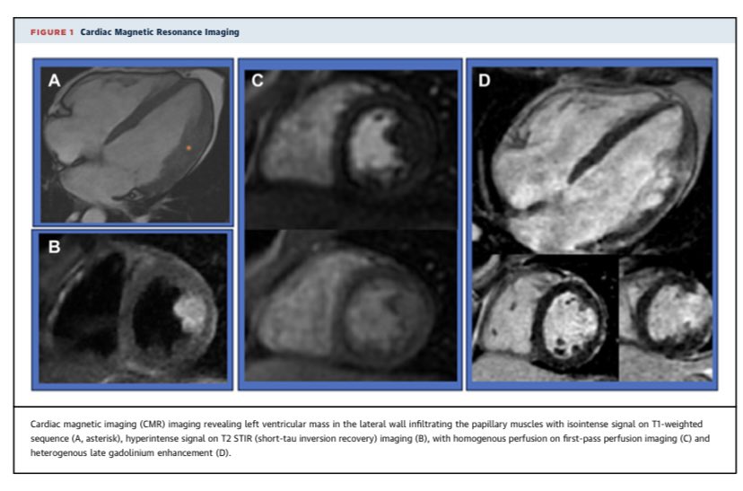 erikahuttce's tweet image. Very humbling case of cardiac mass presenting with PVCs and VT. 
Check out our manuscript for final diagnosis which required endomyocardial biopsy. #echofirst #multimodality #whyCMR #ThinkPET
authors.elsevier.com/sd/article/S26…