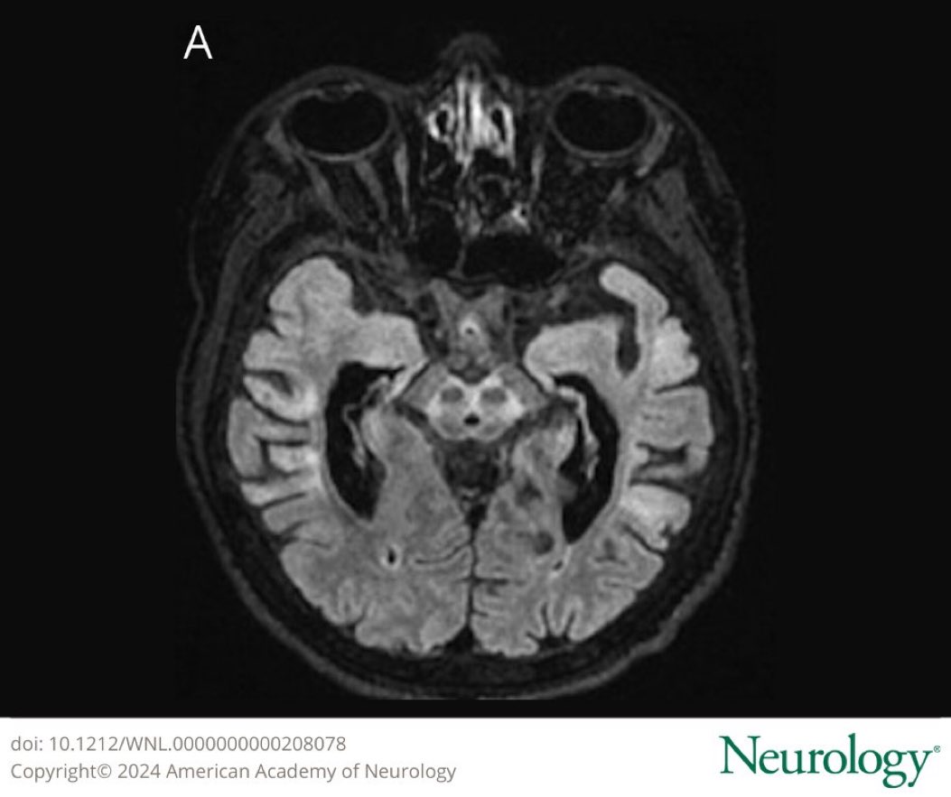 This MRI shows abnormal hyperintensity in the midbrain tegmentum with sparing of the red nucleus and substantia nigra, giving a “face of giant panda” appearance. Learn more about neuroimaging features of Wilson disease in this #NeurologyRF article: bit.ly/48Kf8IE